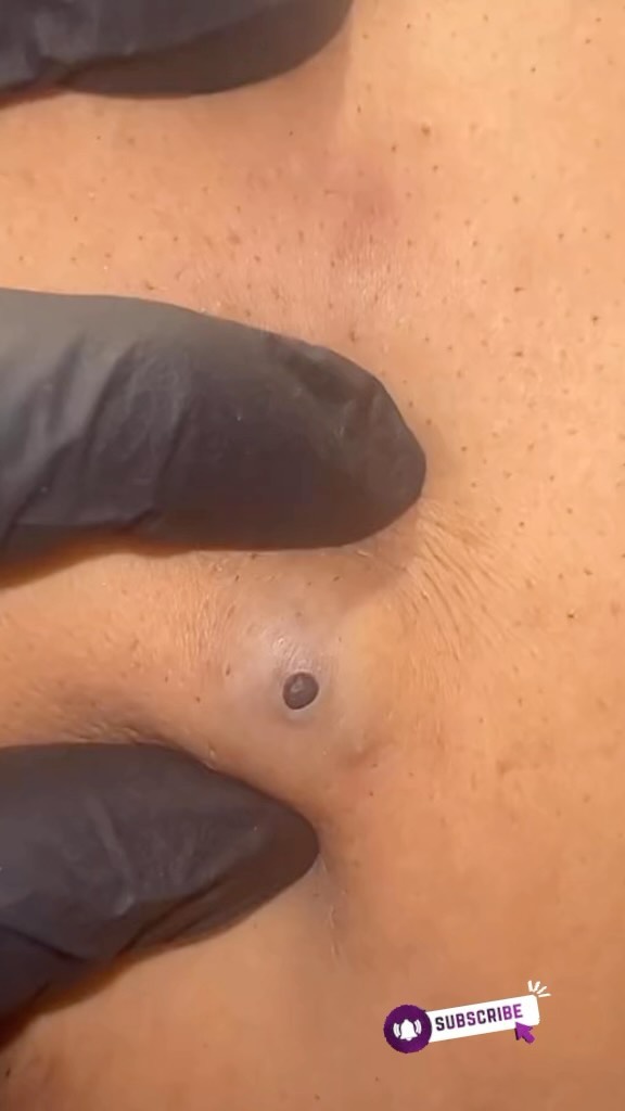Juicy Blackheads Extracted by Dr Pimple Popper