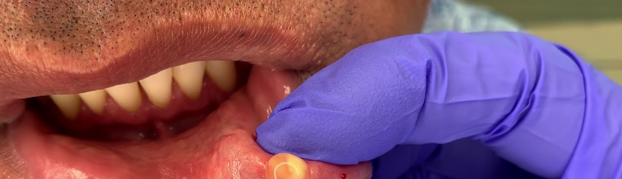 Lower Lip Cyst (Mucocele) Excision
