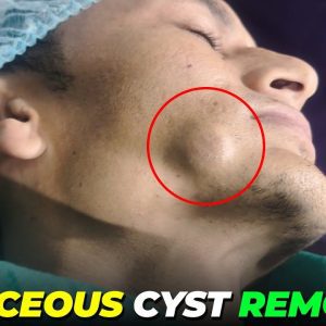Sebaceous Cyst Removal