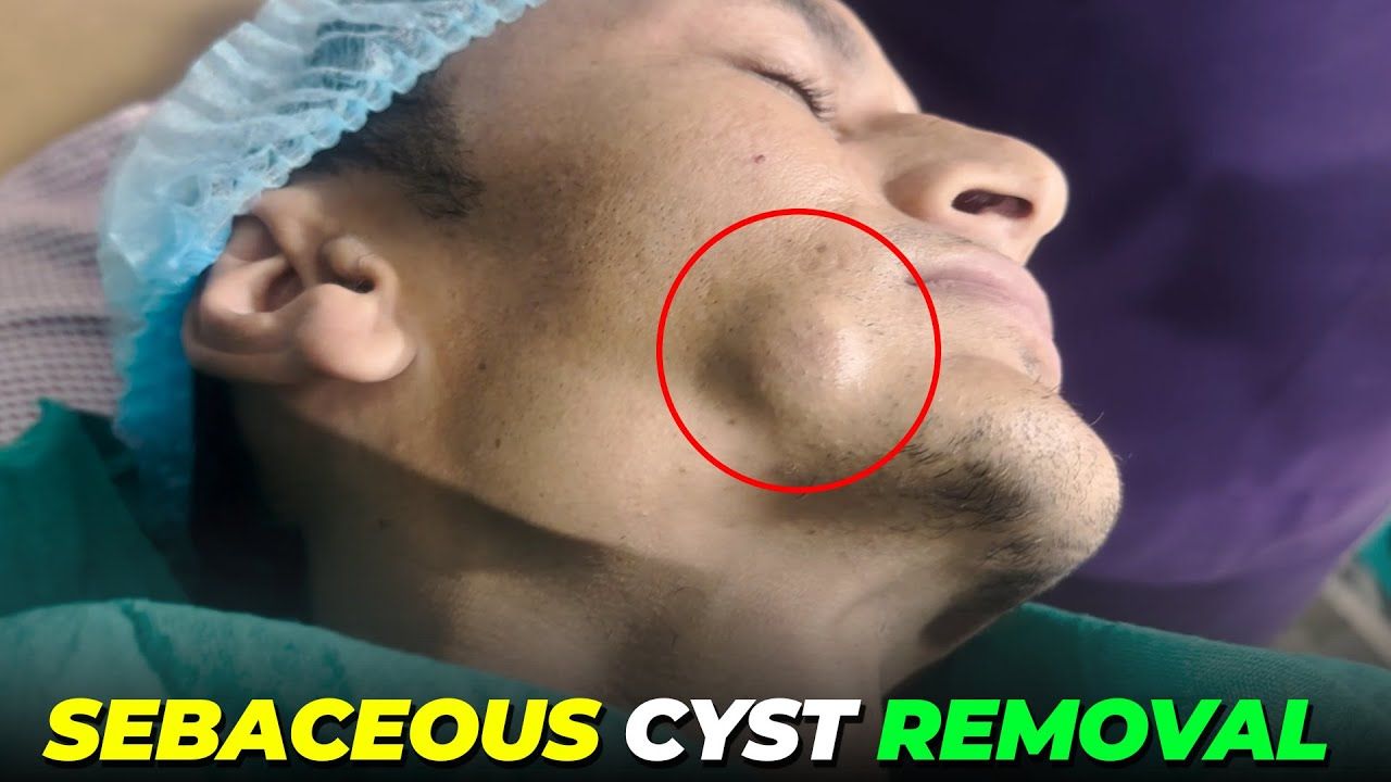 Sebaceous Cyst Removal